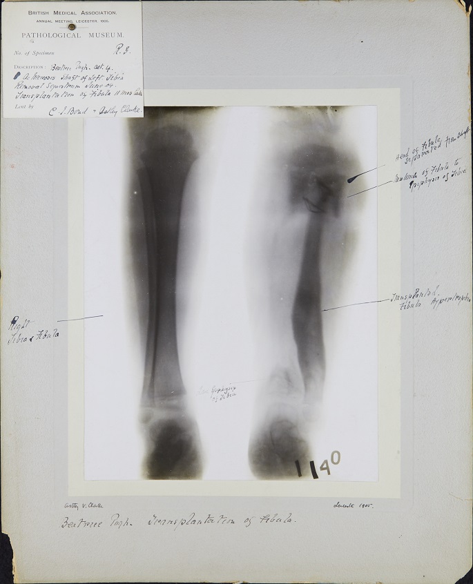 Photograph of X-ray of transplanted fibula mounted on cardboard, with handwritten annotations.
